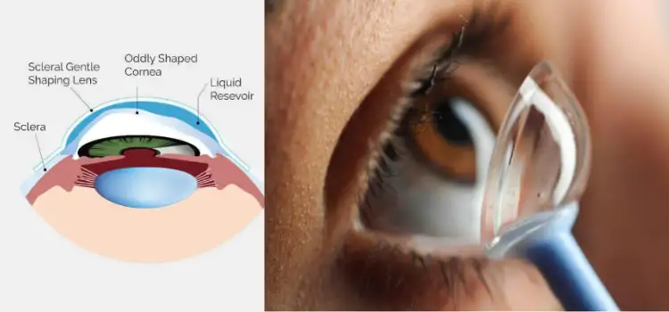 Scleral Contact Lenses: Types, Usage, Safety